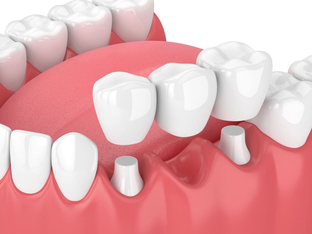 dental bridge worcester