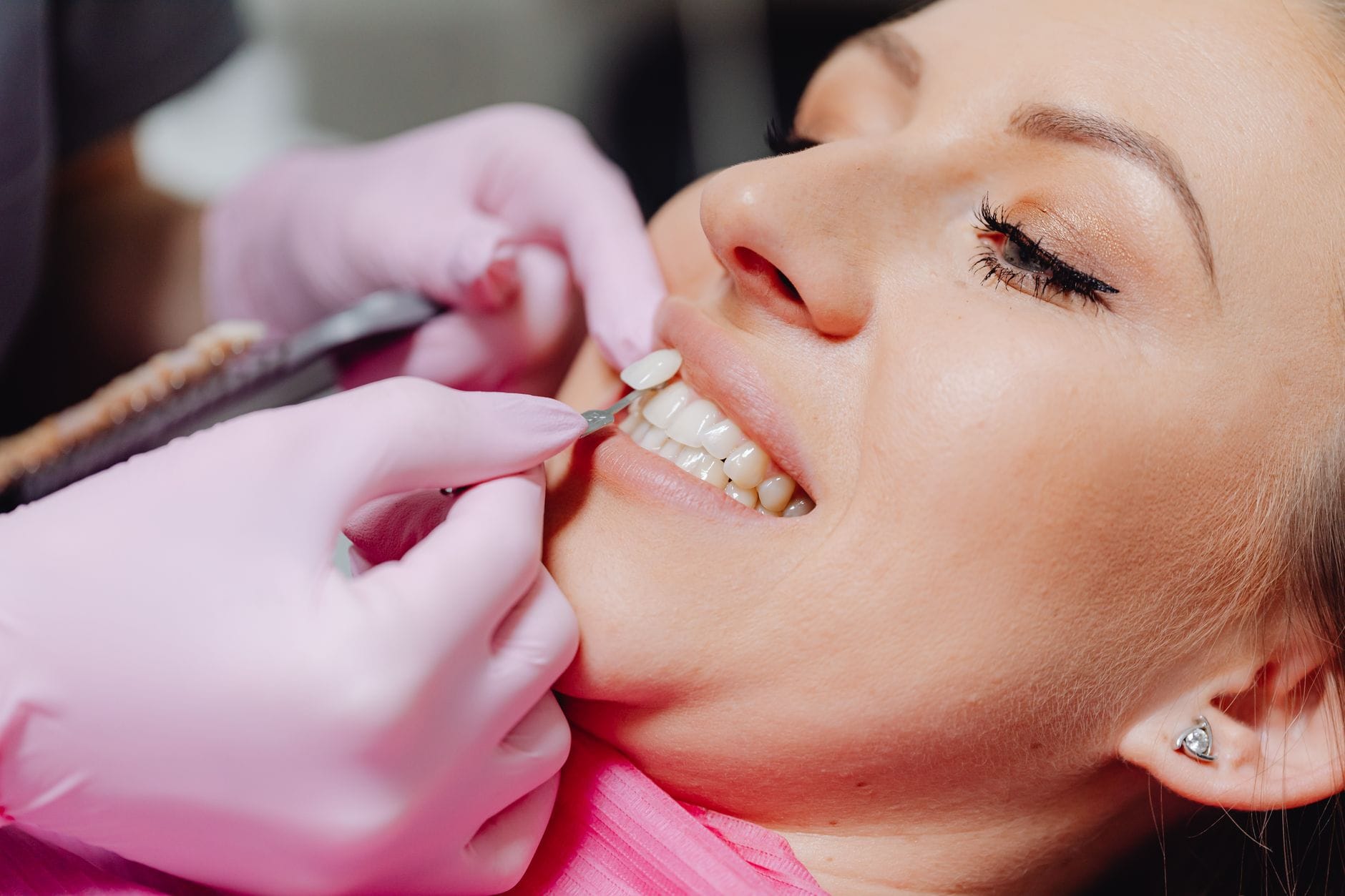 Dental bonding versus veneers comparison