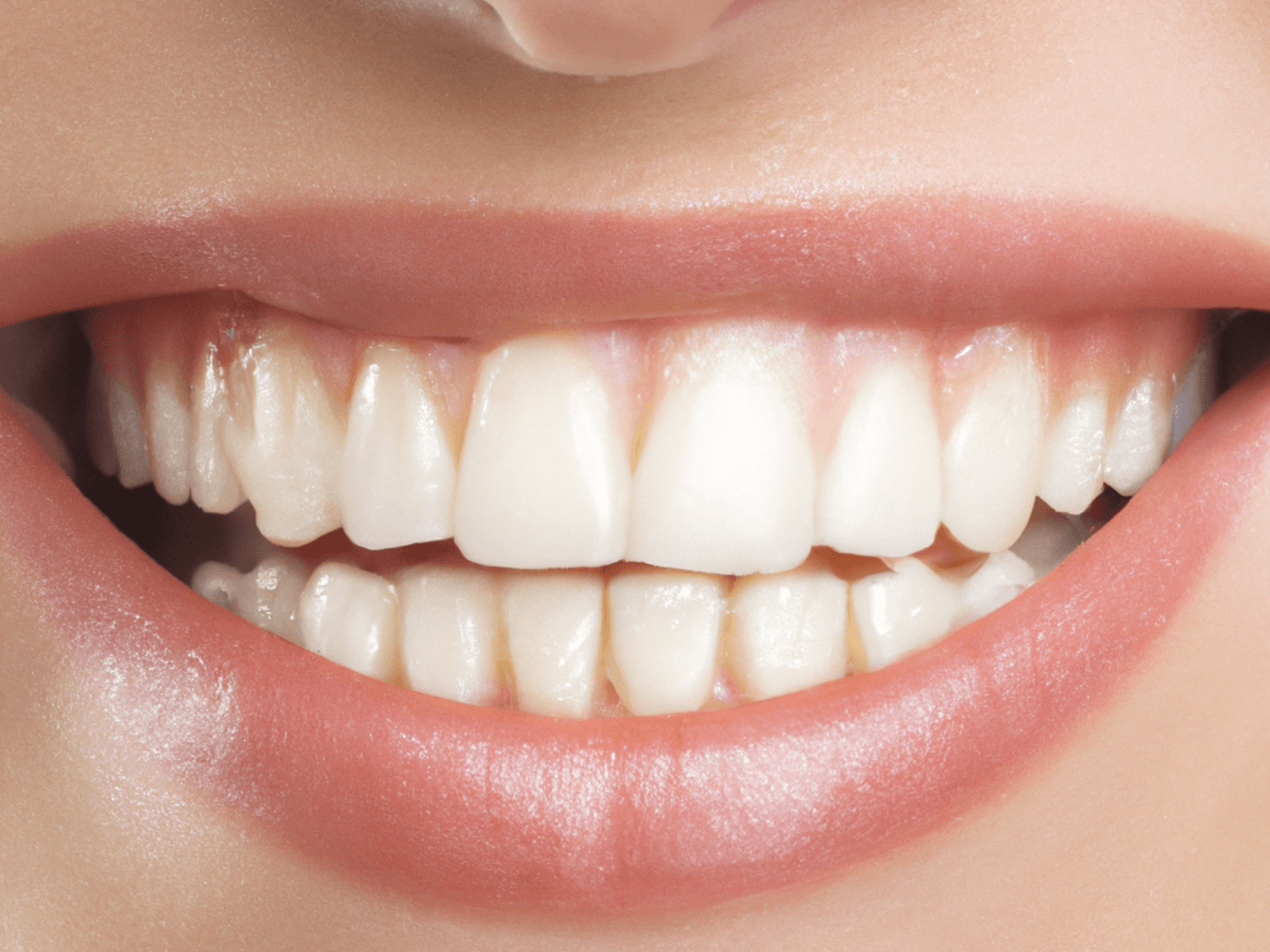 Professional versus at-home teeth whitening
